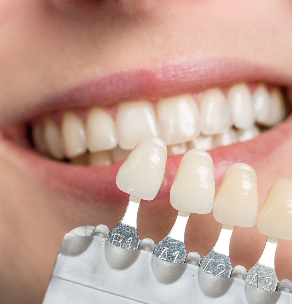 veneers 5050